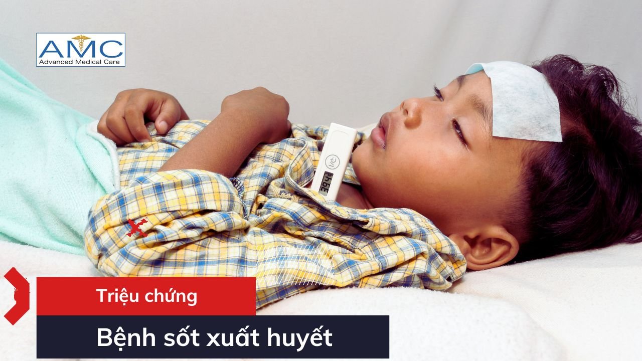 Triệu chứng của sốt xuất huyết Triệu chứng của sốt xuất huyết